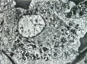 F,68y. | spleen - undefined myelinoid inclusions - clin. susp. leukemia